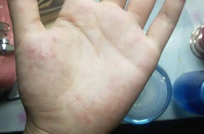 What are the detergent allergy symptoms